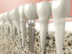 dental implants gouverneur, ny