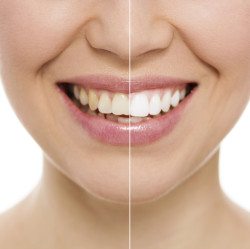 teeth whitening gouverneur, ny