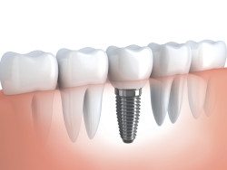 dental implants gouverneur ny