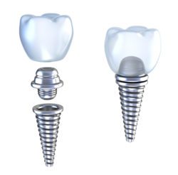 Dental implant graphic of 3D crown with screw in pin