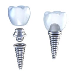 Dental implant graphic of 3D crown with screw in pin