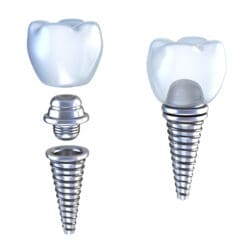 Dental implant graphic of 3D crown with screw in pin