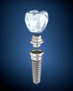 Dental Implant Benefits in Gouverneur, New York