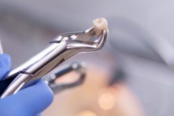 tooth extraction gouverneur ny