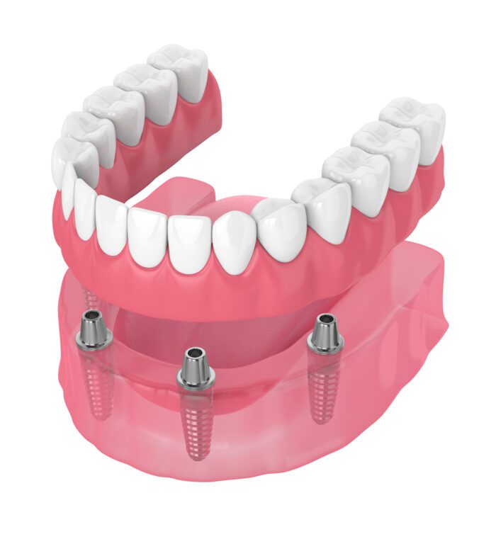 all-on-4 in Gouverneur NY is a great way to restore your bite after missing multiple teeth