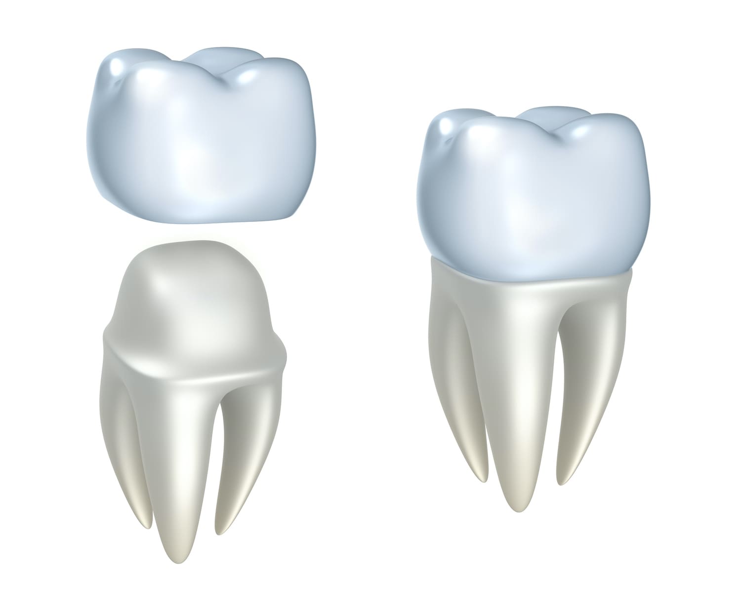dental crowns gouverneur ny