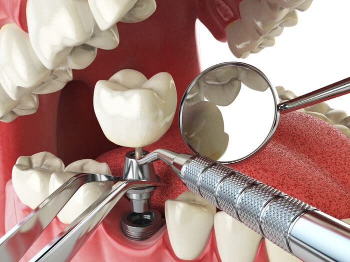 Both dental implants and Invisalign treatments aim to improve dental health and enhance the appearance of your smile.