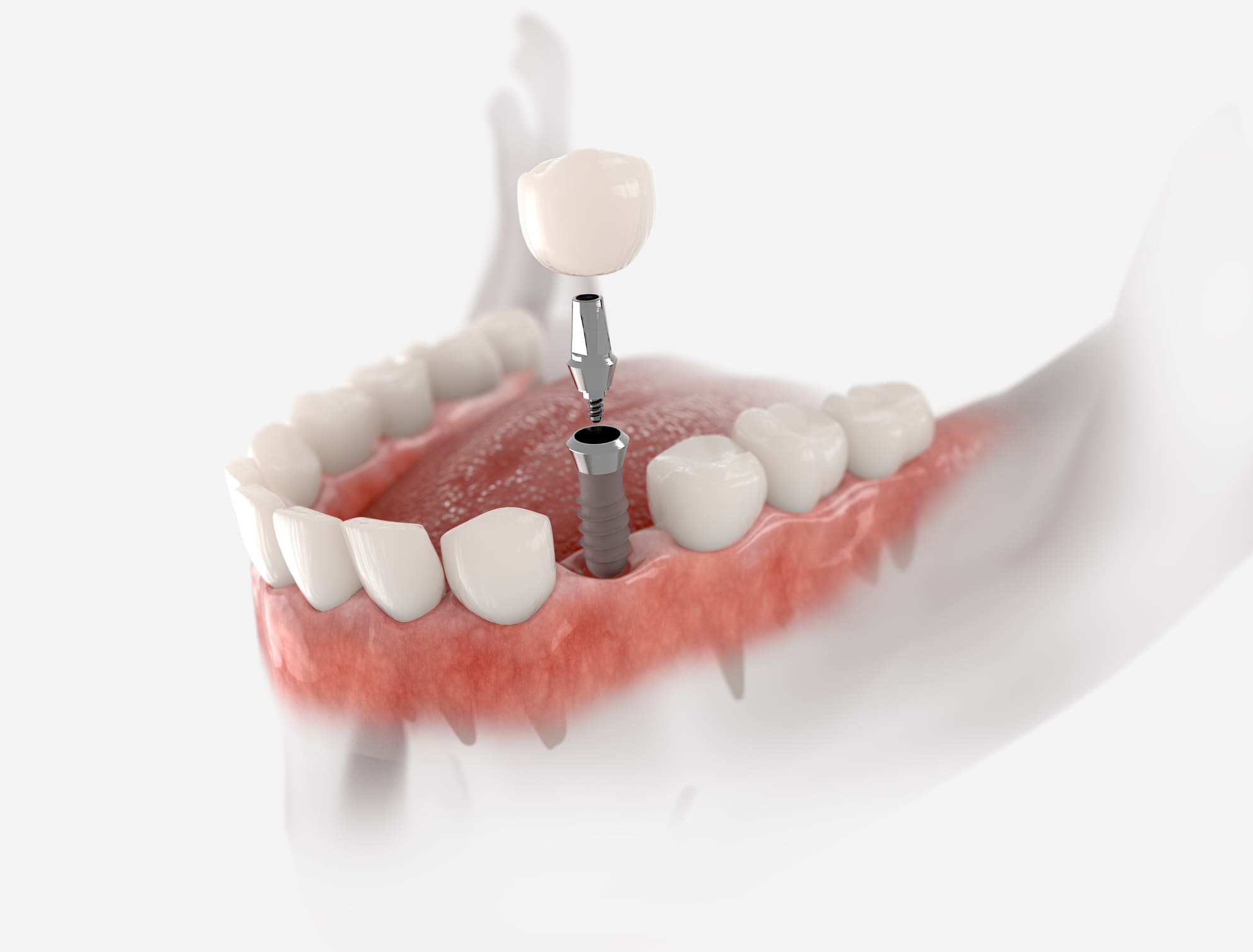 dental implants gouverneur, ny