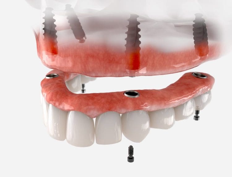 Treatment for missing teeth 