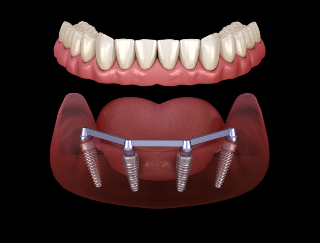 all on x dental implants in gouverneur ny
