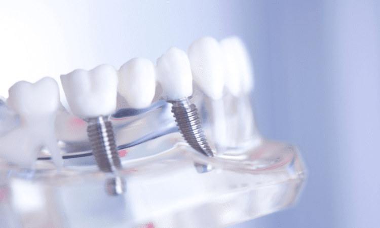 Implant-supported dental bridges combine the stability of implants with the functional coverage of a traditional dental bridge.