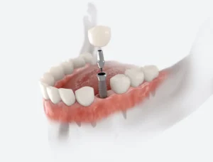 One Missing Tooth, Many Solutions in Gouverneur, NY